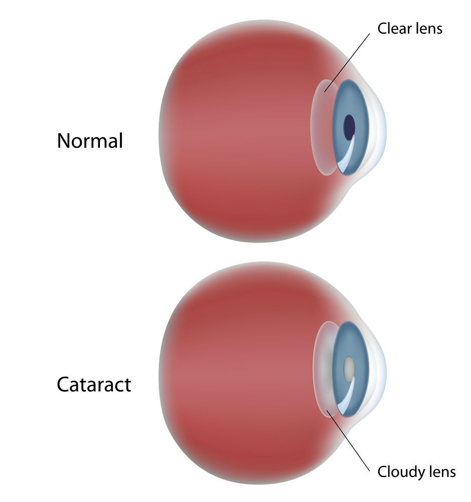 cataract cataracts bluff