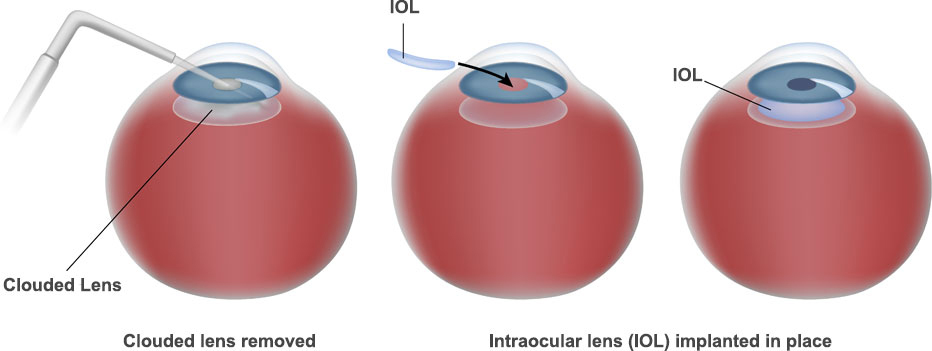 What Is an Intraocular Lens Implant (IOL)?